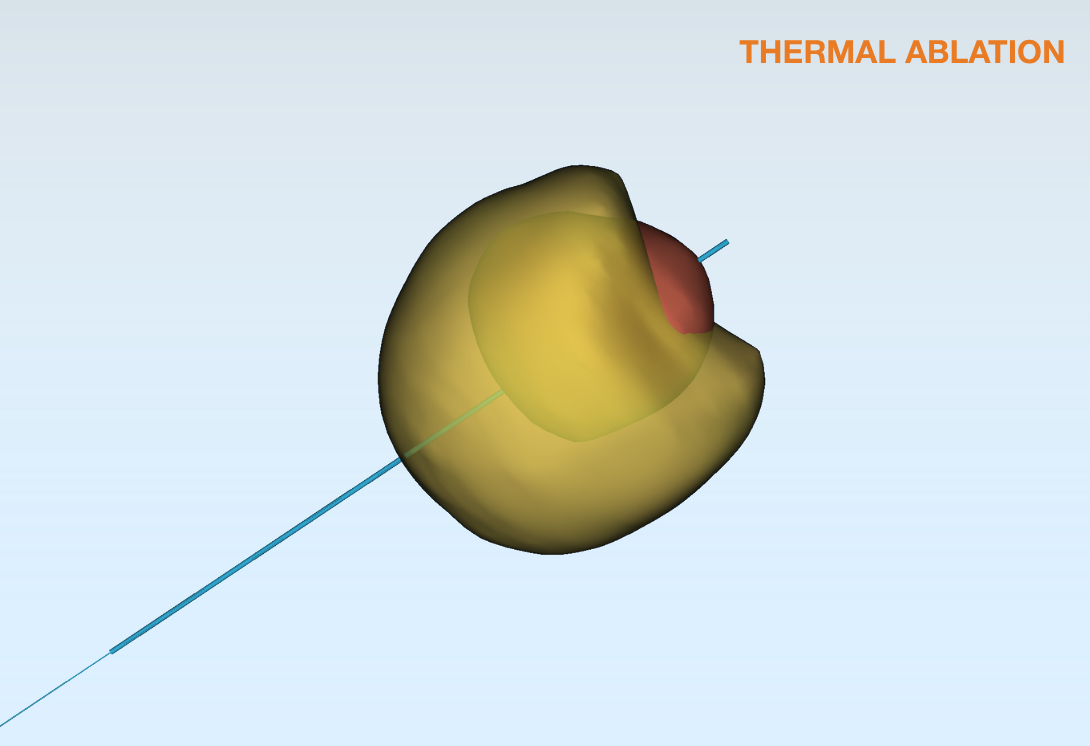 Thermal ablation coverage