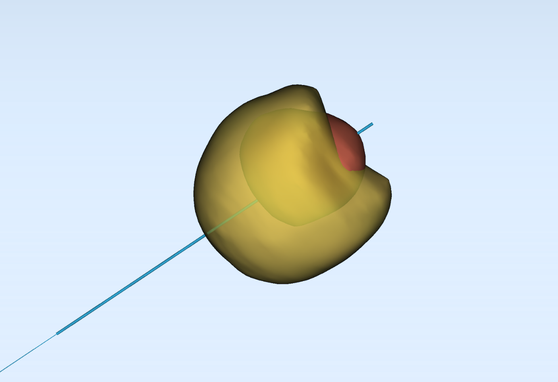 Hapchot patient-specific simulated ablation zone