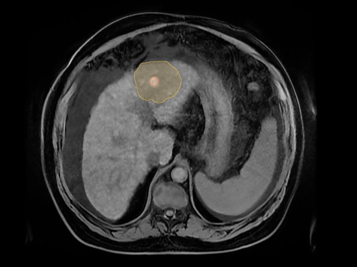 The same MRI with the oedema segmented in yellow and the tumour in red, to measure the margin achieved