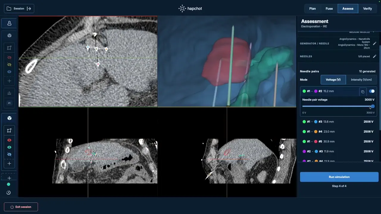 Treatment prediction: the ablation zone simulated for the electrodes as placed