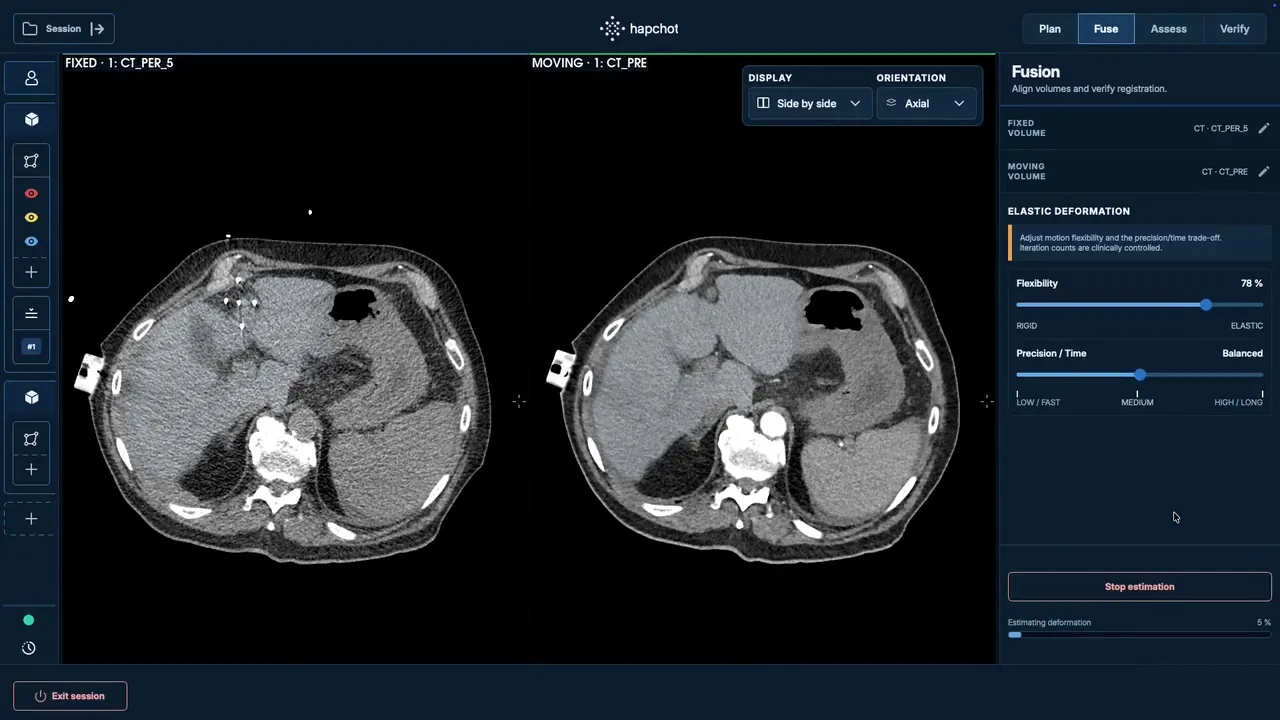 Digital twin: intra-operative anatomy rebuilt by elastic image fusion